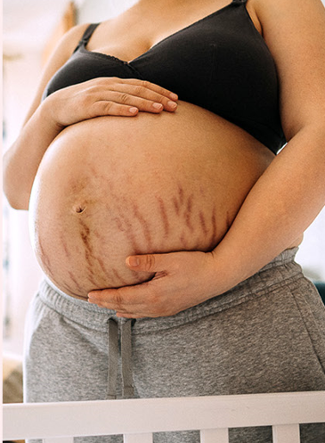 Stretch marks 101   Stretch marks 101