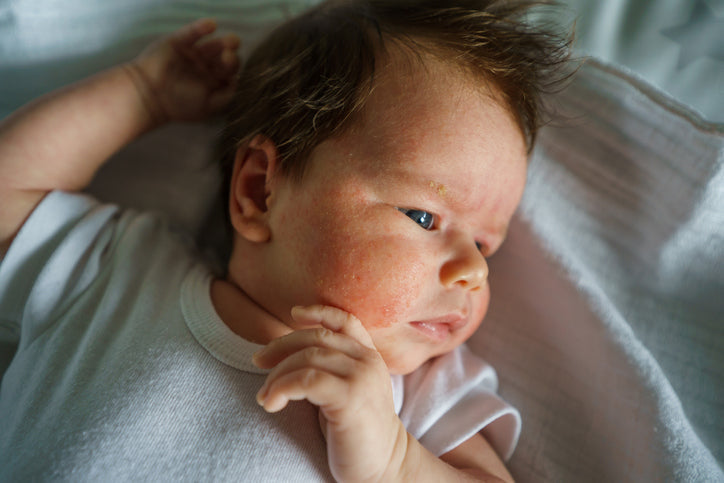 Eczema in babies 