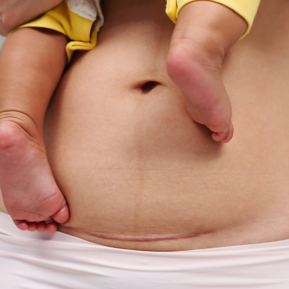  Emotional & Psychological Recovery After a Caesarean 