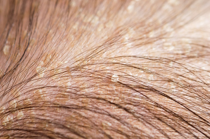  Cradle Cap 