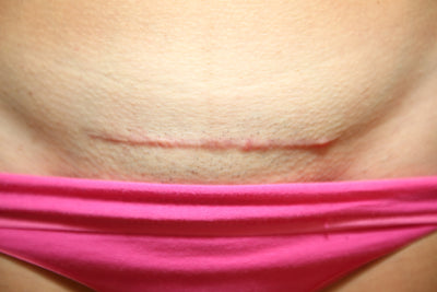Caring for your wound and scar after a C-section