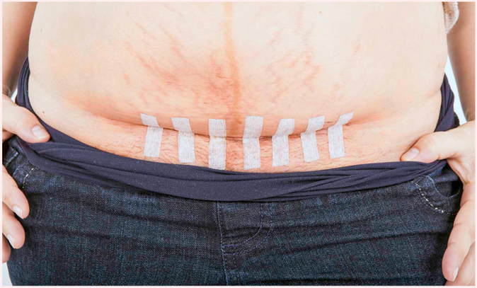  Everything you need to know about C-sections 