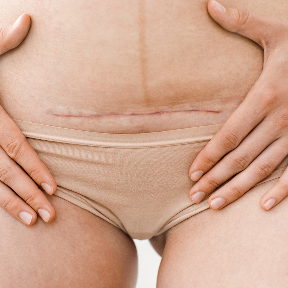  C-section Scar Massage: A Step-by-step Guide 