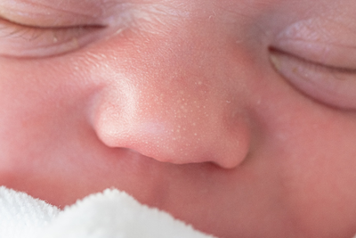 A close-up image of baby milk spots, or milia, appearing as white spots on baby’s skin.