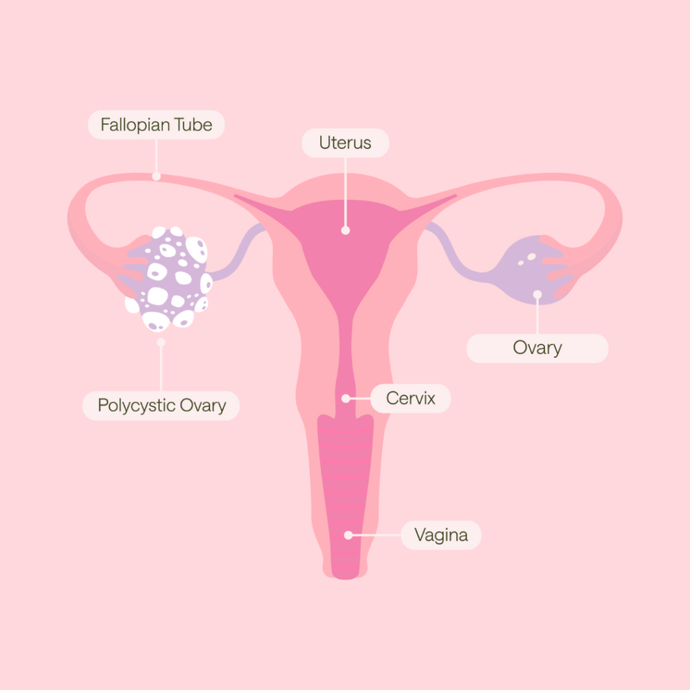  Polycystic Ovary Syndrome (PCOS) 